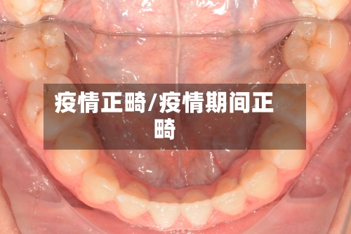 疫情正畸/疫情期间正畸-第3张图片