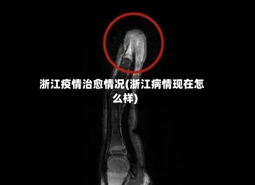 浙江疫情治愈情况(浙江病情现在怎么样)-第3张图片