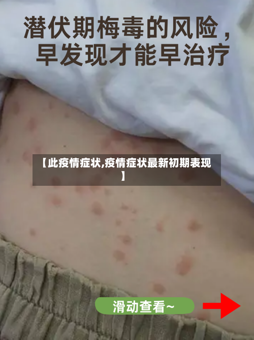 【此疫情症状,疫情症状最新初期表现】-第2张图片