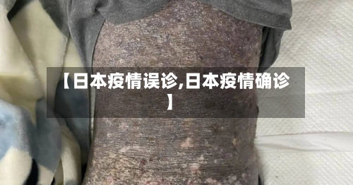 【日本疫情误诊,日本疫情确诊】