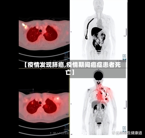 【疫情发现肺癌,疫情期间癌症患者死亡】-第2张图片