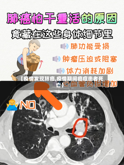 【疫情发现肺癌,疫情期间癌症患者死亡】