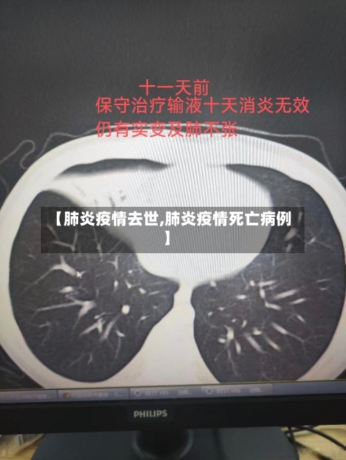 【肺炎疫情去世,肺炎疫情死亡病例】