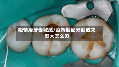 疫情后牙齿敏感/疫情期间牙洞越来越大怎么办-第2张图片