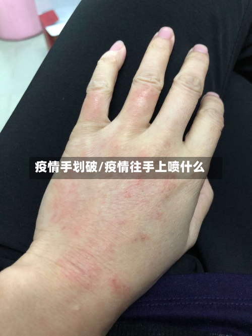 疫情手划破/疫情往手上喷什么