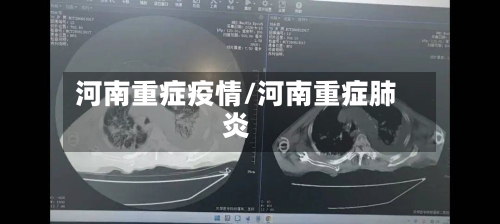 河南重症疫情/河南重症肺炎
