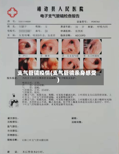 支气管镜疫情(支气管镜亲身感受)