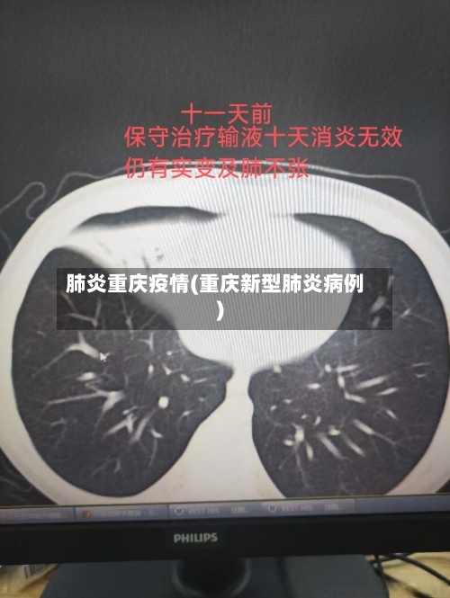 肺炎重庆疫情(重庆新型肺炎病例)