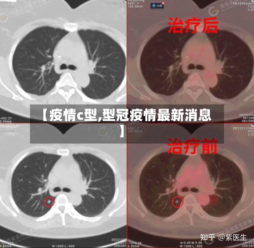 【疫情c型,型冠疫情最新消息】